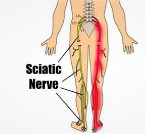 Sciatic Nerve remedy