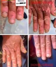 Vitiligo cured with terahertz therapy
