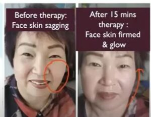 face skin sagging reduced by Terahertz Wand
