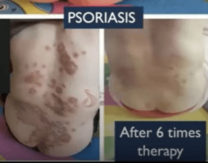 psoriasis improvement